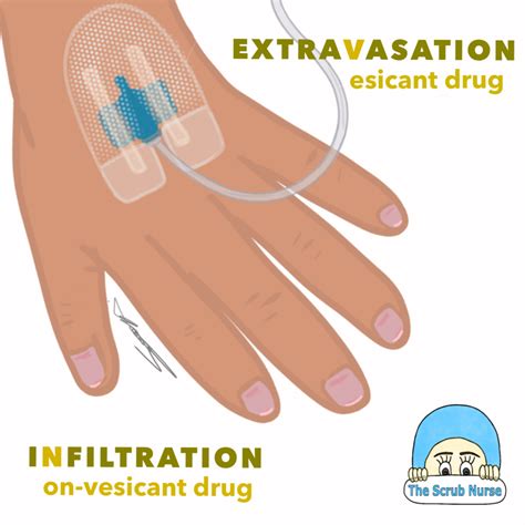 How to tell the difference between Extravasation and Infiltration? - The Scrub Nurse