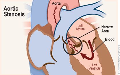 Aortic Stenosis (for Parents) - Rady Children's Hospital (XML)