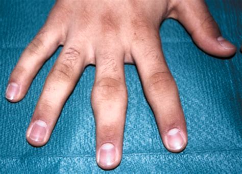 Finger joint swellings in a teenager: juvenile rheumatoid arthritis or a psychiatric disorder ...