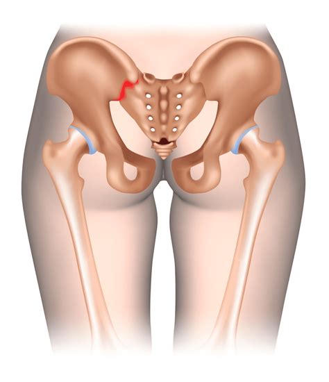 What is Sacroiliac (SI) Joint Sprain & How to Ease the Pain? - Upswing Health