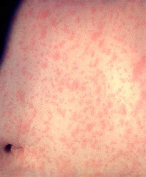 ケンタッキー州で数千人がはしかにさらされた可能性がある、とCDCは言う - JP NewsS