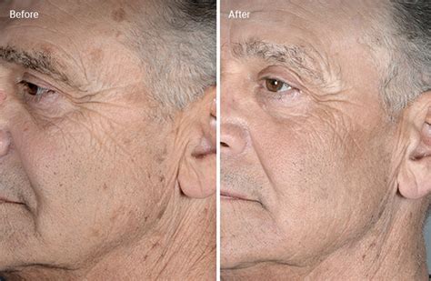 Laser Skin Resurfacing: What It Is, How It Works, Side Effects & Cost