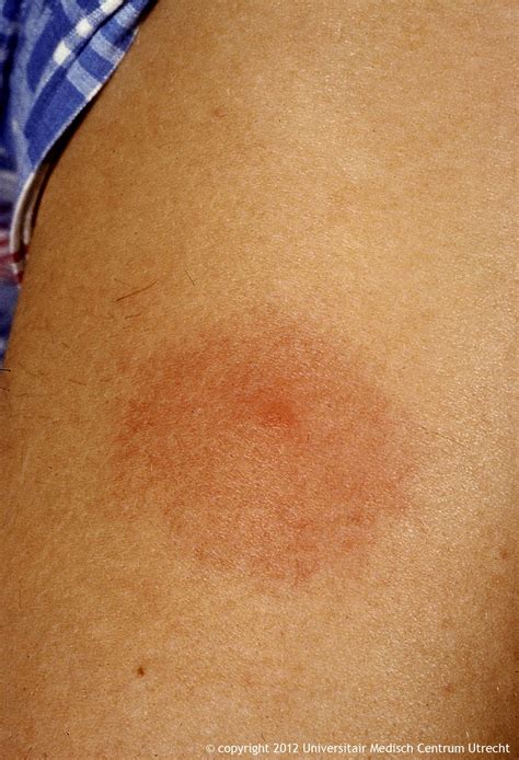 Bulls Eye Rash / A Full Guide On Lyme Disease And Why It Causes Fatigue ...