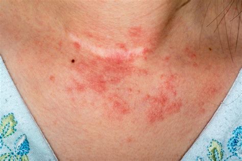 6 types of eczema: Symptoms and causes (2022)