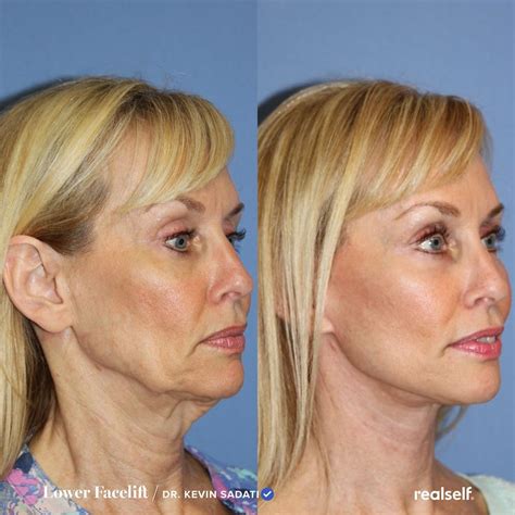 Lower Facelift: What to Expect, Results, Cost | RealSelf | Facelift ...