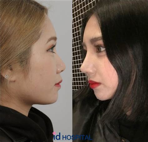 💋 Low nose bridge ->... - ID Plastic Surgery Hospital Korea