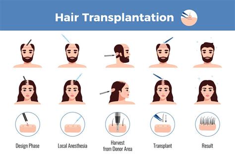 About Hair Transplant Dr Bertram Hair Transplant