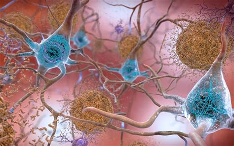Novel Drug Prevents Amyloid Plaques, a Hallmark of Alzheimer’s Disease