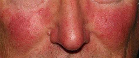 Rosacea - Causes, Symptoms, Cream, Diet & Rosacea Treatment