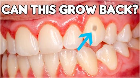 Can Tooth Enamel Grow Back? (How To Prevent Enamel Erosion) - YouTube