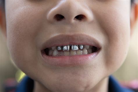 Is Silver Diamine Fluoride Application Right for My Child? - Broad Smiles