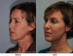 The Laser Face Lift: New, Improved and Available at Southern Surgical ...