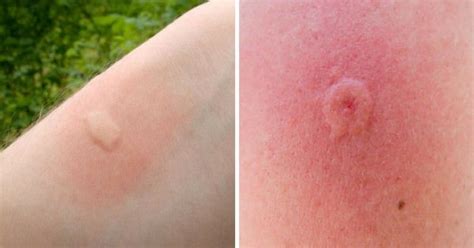 12 Common Bug Bites And How To Recognize Each One | Piqure insecte, Insectes, Trucs et astuces