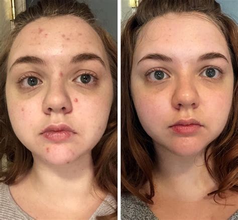 [B&A] The magic of Curology - progress after 4 months of use (routine in comments ...