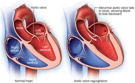 Mitral Valve Prolapse With Regurgitation