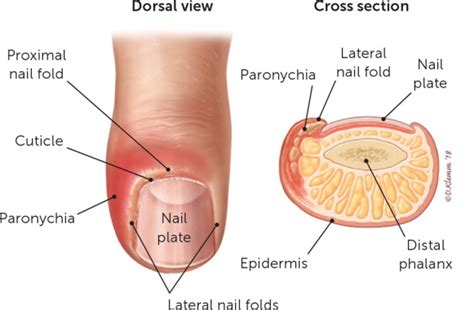 Acute Hand Infections | AAFP