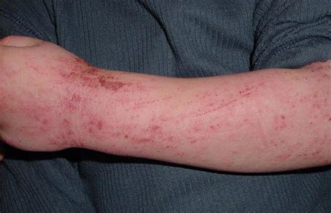 Pediatric Eczema – Fairfield Dermatology