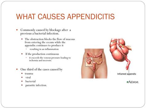 PPT - APPENDICITIS PowerPoint Presentation - ID:2176545