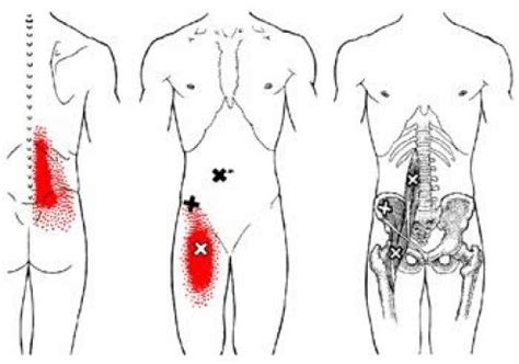 Pin on Psoas Release