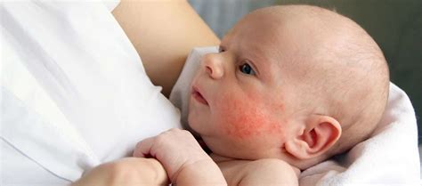 Home remedies for baby heat rash - Best 8 Remedies - APOMDIN