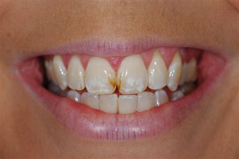 Stains Between Teeth - How to get rid of black spots between teeth ...