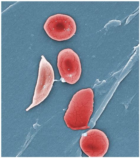 Anemia, Sickle Cell; Hemoglobin S Disease