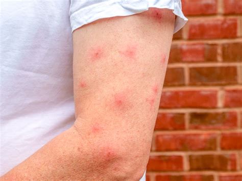 Mosquito Bite Blisters: What Causes Them and How to Treat Them