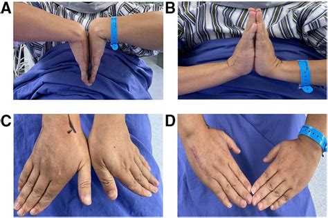 The range of motion of bilateral wrists of a patient in the last ...