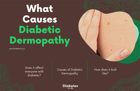 Diabetic Dermopathy Definition And Overview Diabetes Skin Symptoms – NBKomputer