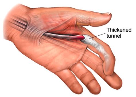 Trigger Finger – Aberdeen Virtual Hand Clinic