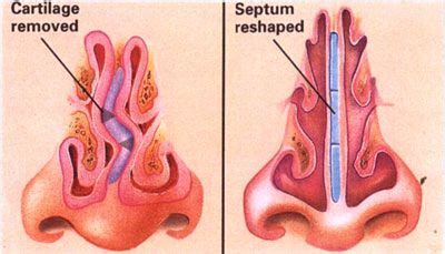 Septoplasty and Turbinate Reduction - Rhinoplasty Clinic Sydney | Nasal ...