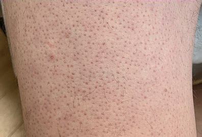 Keratosis pilaris - Causes, Symptoms, Treatment - Derma.Wiki