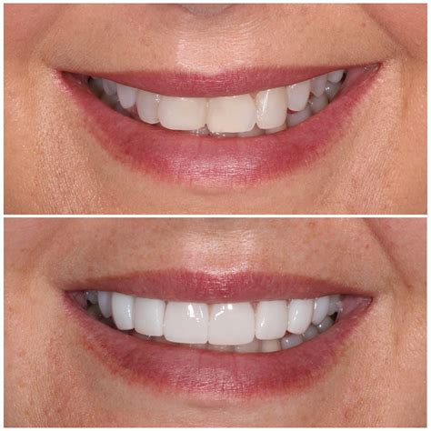 Teeth Veneers Before And After