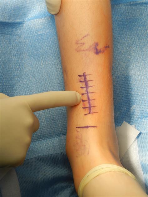 Tibia Anterior Approach - Approaches - Orthobullets