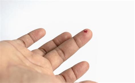 Bleeding Finger Stock Photos, Images and Backgrounds for Free Download