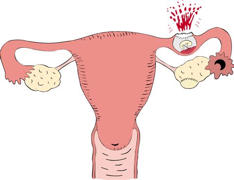 Infertilidade Feminina: outubro 2013