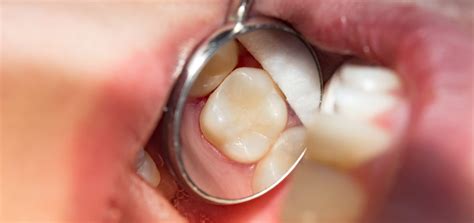 How Much Does Cavity Filling Cost? - North York Dental Clinic