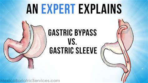 Gastric Bypass in Mexico | Packages from $5,195 to $6,495