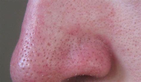 Large Pores on Nose Causes and Ways to Shrink Them - Skincarederm