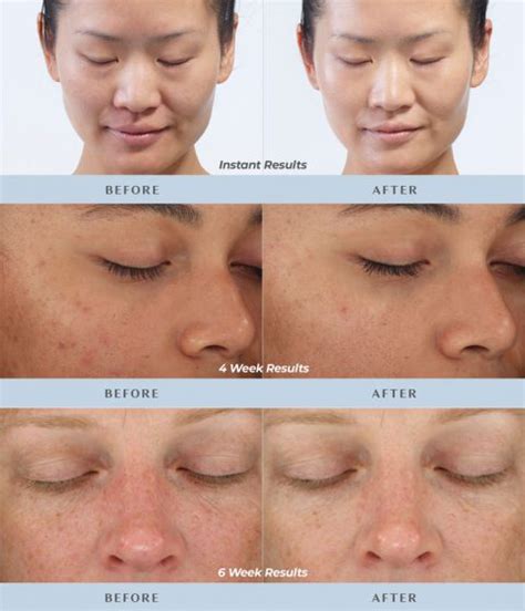 DiamondGlow Facials - LifeTime Dermatology