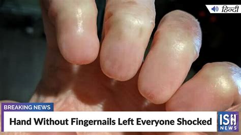 Hand Without Fingernails Left Everyone Shocked | ISH News - YouTube