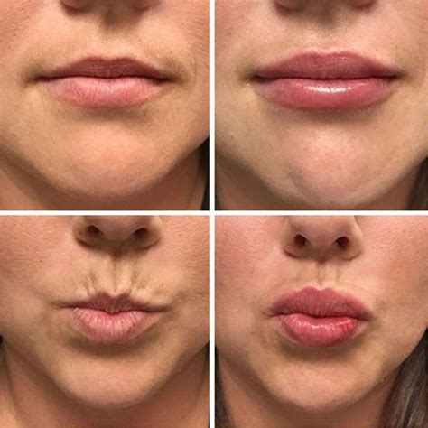 What to Know About Lip Fillers and How to Choose the Best One for You