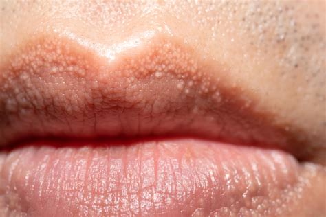 Por qué aparecen puntos blancos en los labios