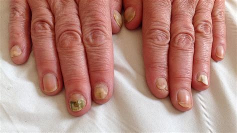 What Causes Fingernail Fungus? Symptoms and Treatment | ND Nails Supply