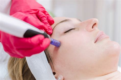 Top Benefits of Micro-needling