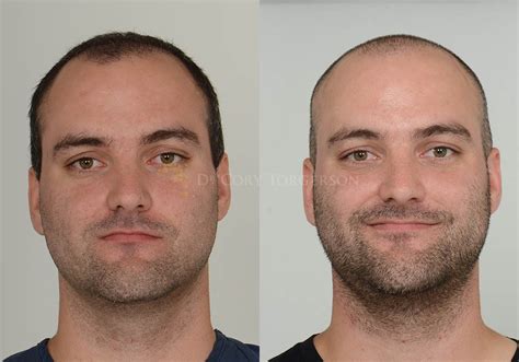 Chin Implant Before & After Gallery | Dr. Cory Torgerson