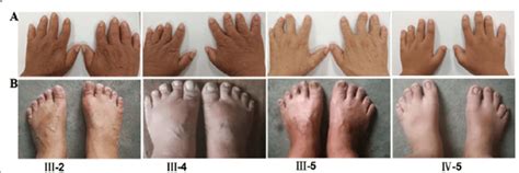 Features of other affected family members with brachydactyly type A1 ...