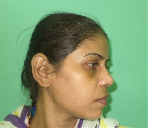 Rhinoplasty (Nose Job) Before & After Results - Saraswat Hospital