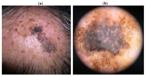 Skin Cancer Spots On Scalp