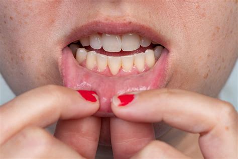 Will Receded Gums Grow Back? The Surprising Answer